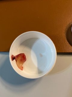 Polyp that was removed from his ear