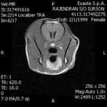 The MRI report shows the tumor eating her right skull and muscles