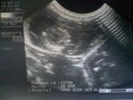 Chitam baby in ultrasound