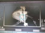 Lastest x-ray showing union of bones